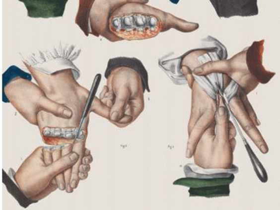 Ампутиране на пръсти. Richard Barnett / The Wellcome Trust